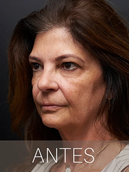 Antes Bioestimuladores Oblicuo