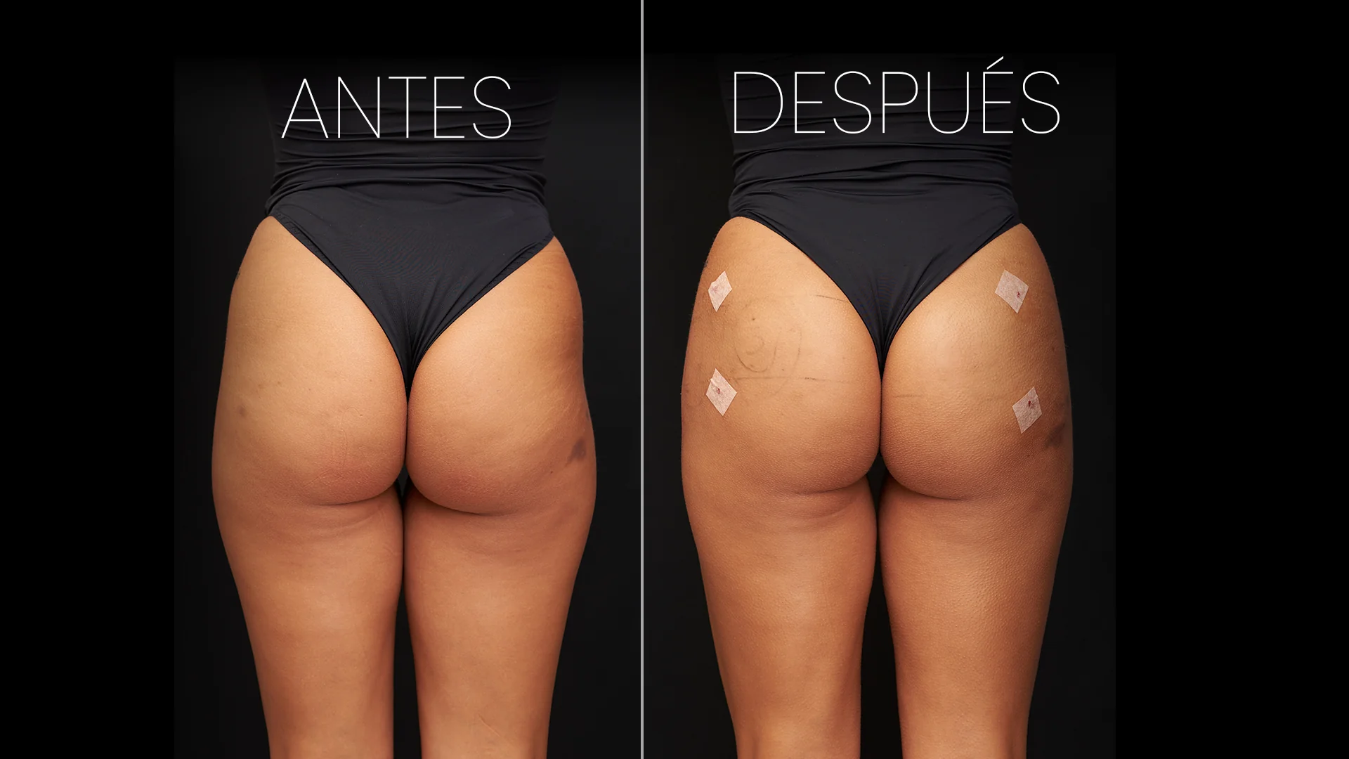 Antes y Después Remodelación de Glúteos