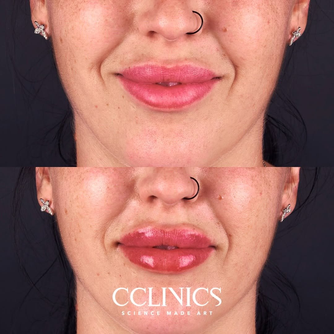 Aumento de Labios - Caso 1