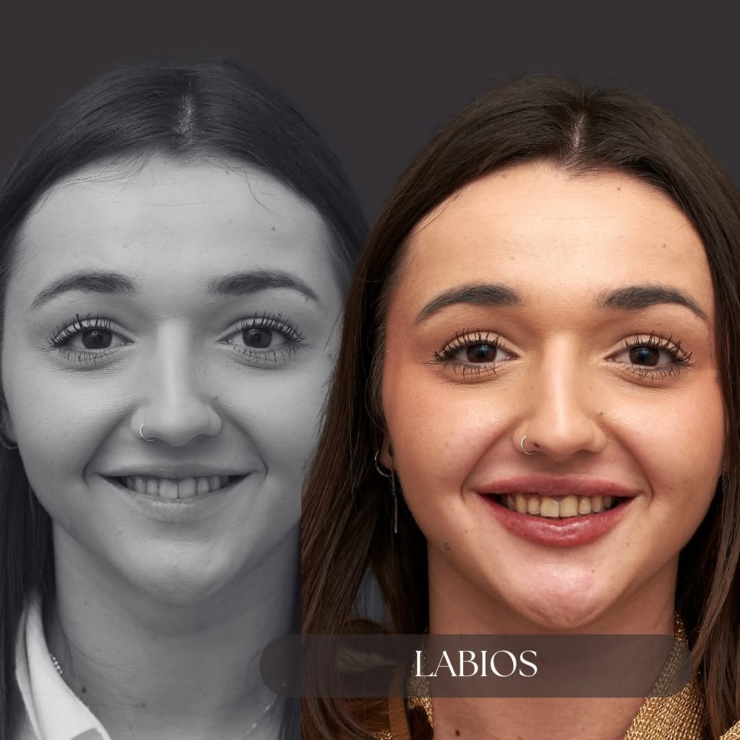 Aumento de Labios - Caso 2