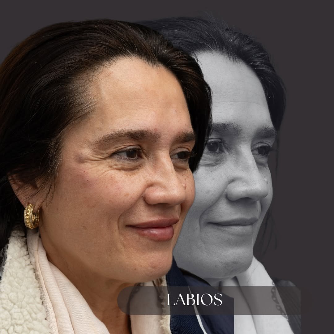 Aumento de Labios - Caso 3
