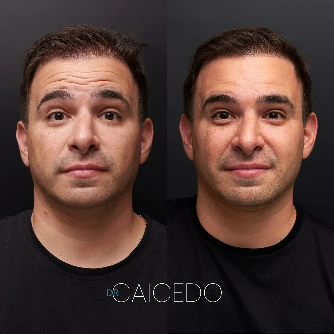 Caso 2: Neuromoduladores
